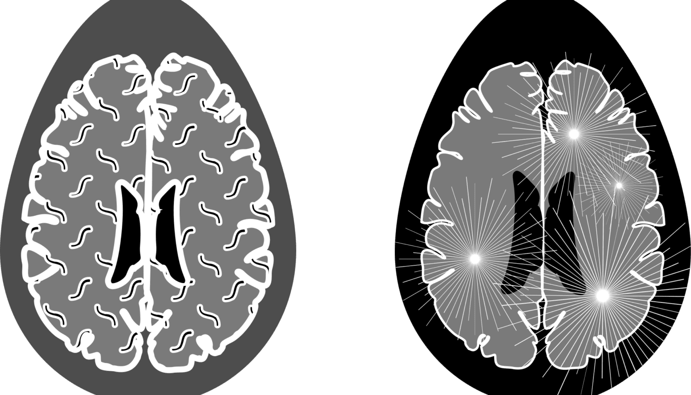 Guide to live a normal life with Multiple Sclerosis