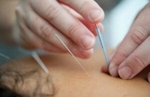 Acupuncture: Everything You Need to Know