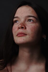 a girl with red acne scars