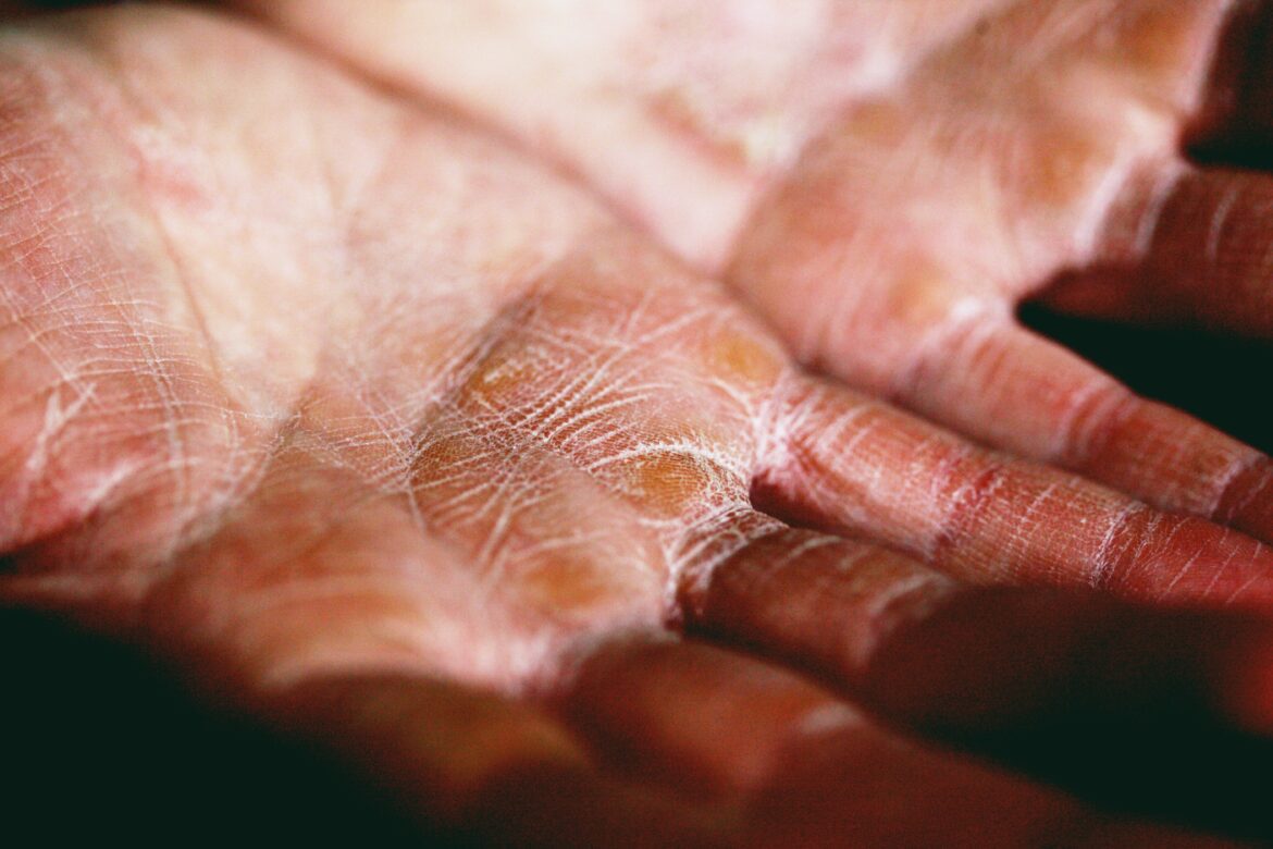 dry hands by eczema - HealthMed.org