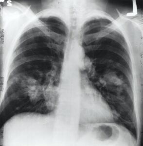 lung cancer causes