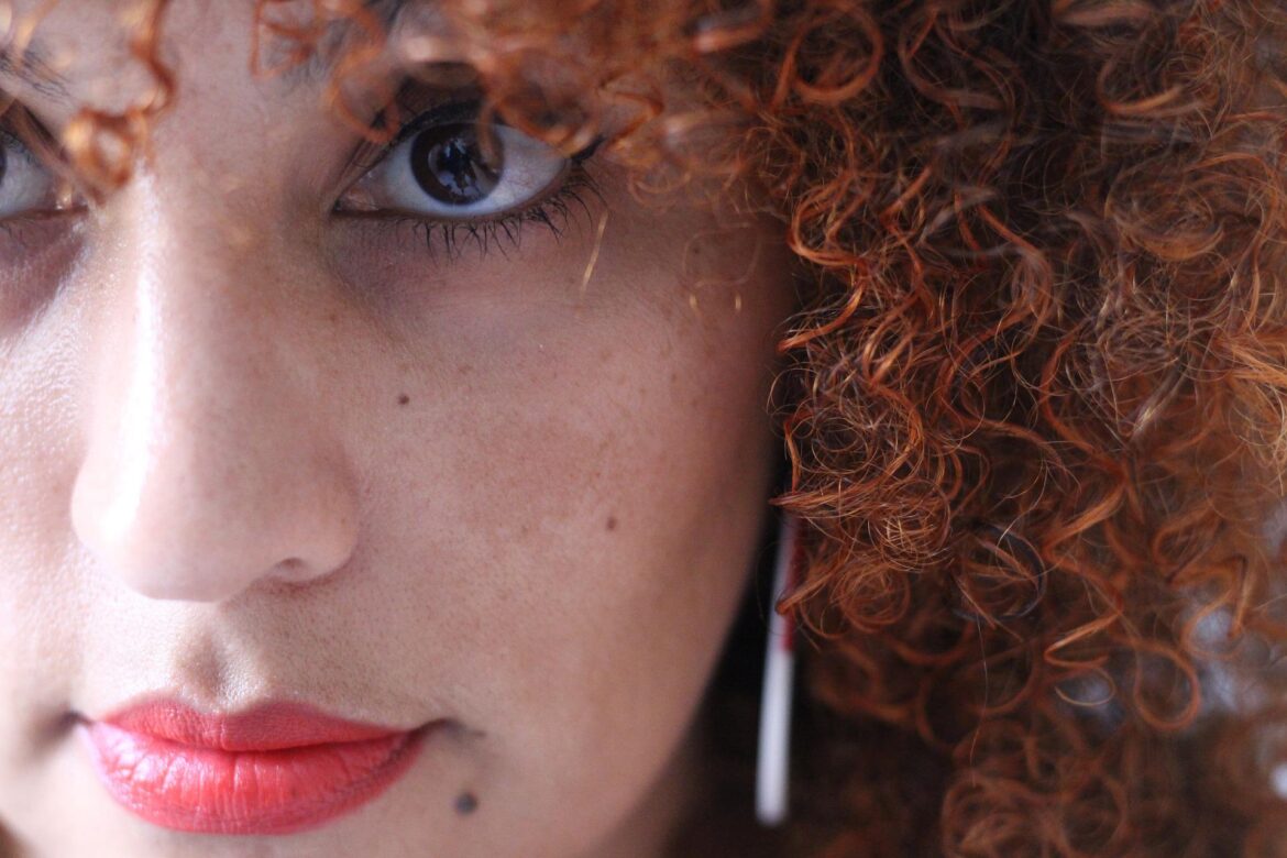 melasma-home-remedies melasma-home-remedies