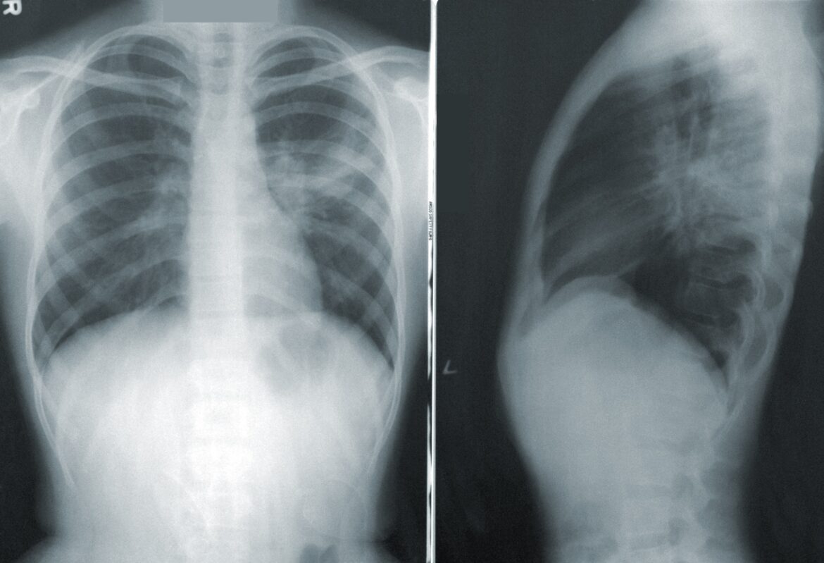 cdc-NMZdj2Zu36M-unsplash lung x ray
