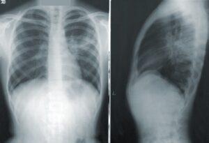 lung x ray